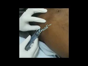 Coleta de Líquido Ascítico - Ascitic Liquid Collection