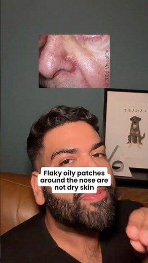 Flaky patches around your nose that won't respond to moisturizer?