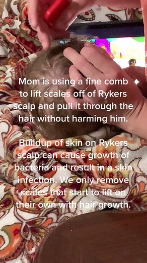 Safe Removal of Skin Buildup on Scalp for Ichthyosis Warrior - Skin Scale Removal