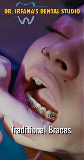 Traditional Braces Treatment | Dr. Irfana's Dental Studio