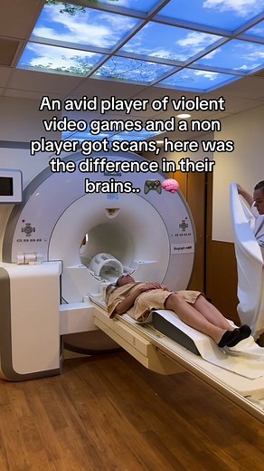 A comparison of functional MRI brain scan results between an avid player of violent electronic games and a nonparticipant show the player's increased activation in the caudate nucleus, thalamus and anterior cingulate-all areas that are part of the reward system. A growing body of research indicates there may be a cause and negative effect relationship, as well as a negative one between prolonged electronic device screen time and increased reward system activity. More research is needed. #mri #br