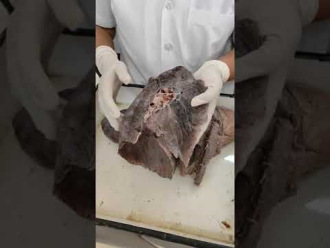 Lung Borders and Surfaces