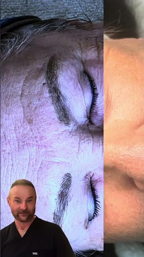 CO2 + RF Microneedling Before & After Results