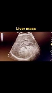 Liver mass #hepatocellularcarcinoma #livermass #hepaticcarcinoma #ultrasoundmadeeasy | Ultrasound made easy