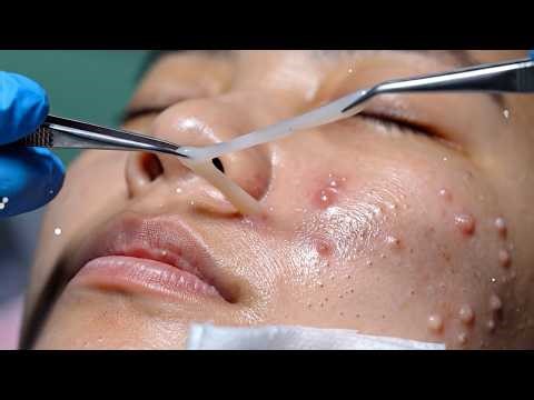 Giant Ear Blackhead Extraction | Dr. Pimple Popper’s Most Satisfying Transformation, #1896