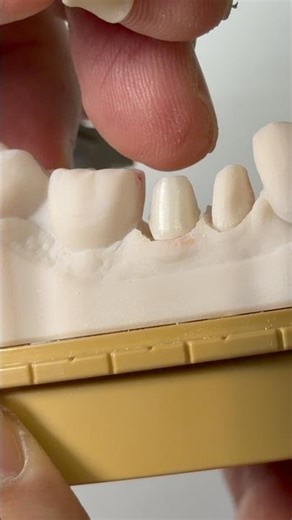 Telescopic coping for Dr. Sharitha Uchil in Michigan