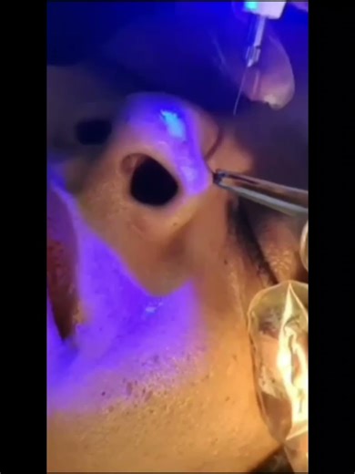 Mole removal no blood less no pain less laser treatment #skincare #skincareroutine #skincaretips