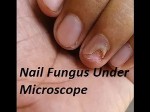 How does a nail fungus look like under Microscope