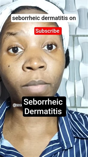 How I Cleared Seborrheic Dermatitis on my Face | Day 2 #shorts #skincare