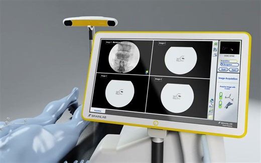 Brainlab Fluoro 2D Registration and Navigation