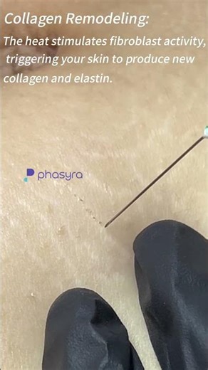 💡Science of phasyra plasma: Deeper Fix for Stretch Marks