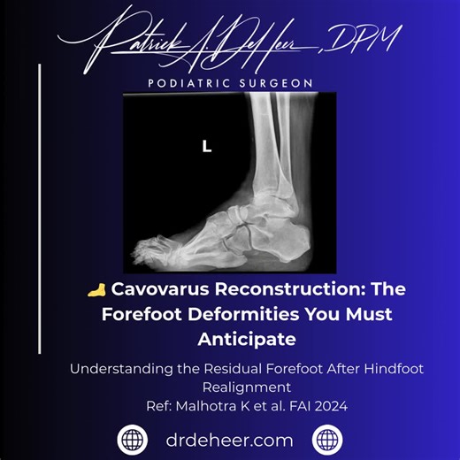 Cavovarus reconstruction is often taught as a series of procedures — calcaneal osteotomy, tendon transfers, first metatarsal dorsiflexion osteotomy, and occasionally midfoot procedures. But it may be more useful to think about the problem from a biomechanical perspective first. The goal of surgery is to restore hindfoot alignment and reduce the talonavicular joint, which re-establishes the normal relationship between the rearfoot and midfoot. Once that occurs, the true residual forefoot deformit