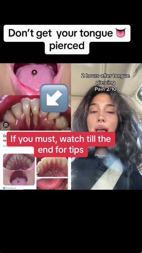Preventing Gum Recession from Tongue Piercing
