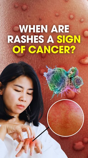 8.3K views · 22 reactions | When Are Skin Rashes A Sign of Cancer ❓...