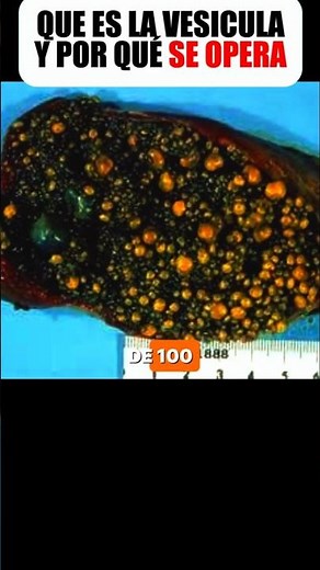 What is the gallbladder and why is it operated on? #health #prevention
