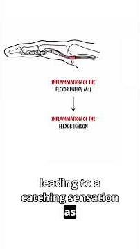 Stenosing tenosynovitis: why the finger catches? #handanatomy #triggerfinger #medicaleducation