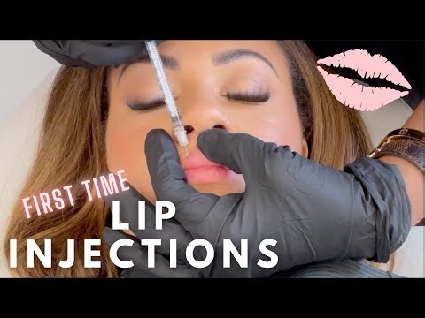 LIP INJECTIONS | first time process | BEFORE DURING AND AFTER RESULTS | LUXE BEAUTE CLINIC