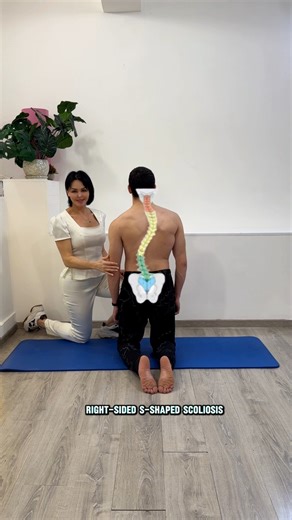 S-shaped right-sided scoliosis. X-ray confirmed correction: Thoracic 35° → 30° Lumbar 37° → 26° Asymmetric corrective exercise. Thoracic derotation · Lumbar decompression. Marina Ispiryan — Asymmetric Method Online consultation available via website 🌐 verginiacenter.com 📲 WhatsApp: 374 98 149 914 #scoliosis #scoliosistreatment #scoliosisrehabilitation #asymmetricmethod #asymmetricexercise #spinecorrection #posturalrehabilitation #nonoperativecare #rehabilitation | Verginia Center