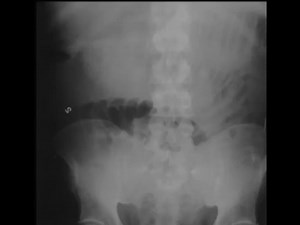 X-Ray Sunday Small Bowel Obstruction | CTisus: Cutting edge information on body CT (Computed tomography). | Facebook