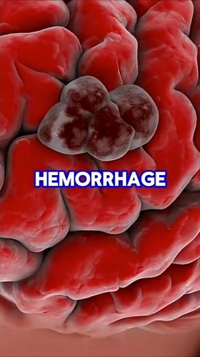5 Early Signs of Brain Haemorrhage You Shouldn’t Ignore | Supermely Health