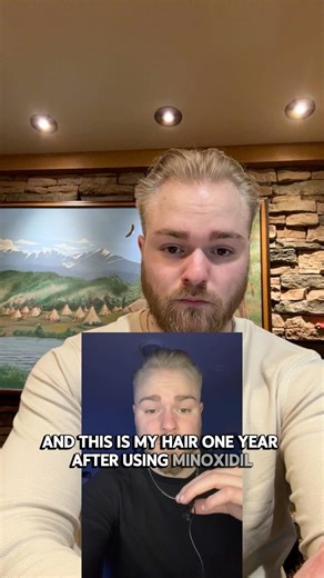 Minoxidil Before and After 1 Year…..#minoxidil #minoxidilresult #finasteride #hairregrowth #looksmax