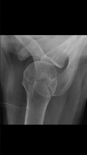 Os acromiale #xray