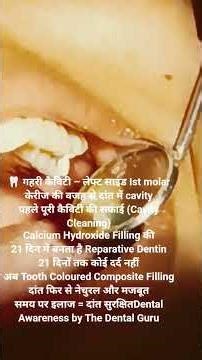 दांत में गहरी कैविटी का बिना दर्द इलाज | Calcium Hydroxide & Composite Filling #thedentalguru