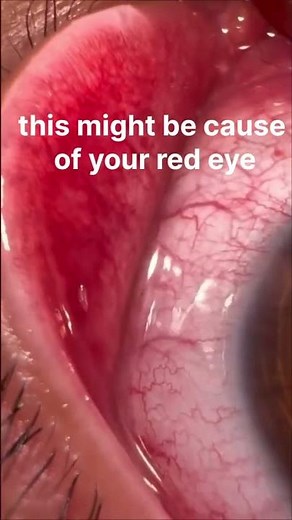 Crawling Worm in Eye: Causes, Symptoms, and Treatment #eyecare