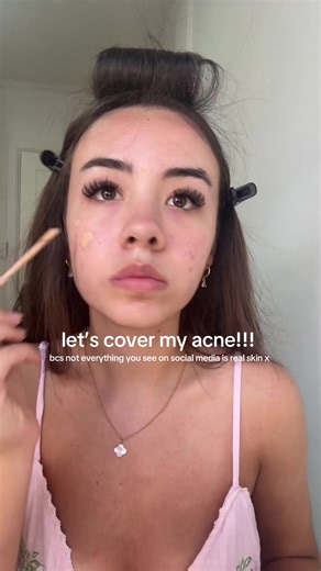 Covering Acne: A Real Skin Makeup Tutorial