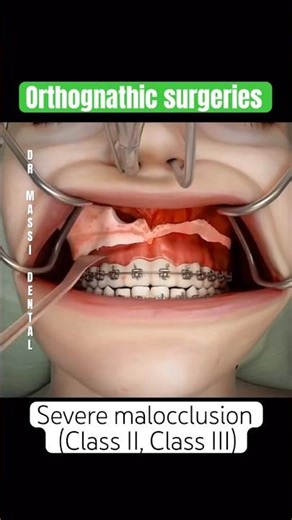 Jaw Correction,Severe malocclusion (Class II, Class III)