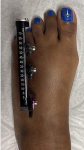 BRACHYMETATARSIA is a congenital deformity that happens at birth. It...