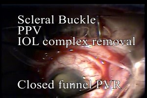 Bandage Lens Technique (BLT) for Corneal Clarity During Vitrectomy  - Eyetube