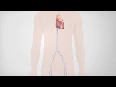 Radiofrequency Catheter Ablation