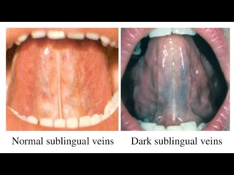 TONGUE EXAMINATION OF HYPOGLOSSAL (SUBLINGUAL) VEINS