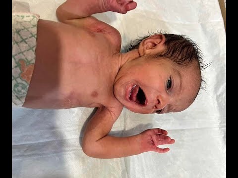 🔔 Latest Baby Malnutrition Update 2026: New Tools, AI Forecasts & Crisis Alerts