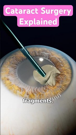 Cataract Surgery Explained 👁️