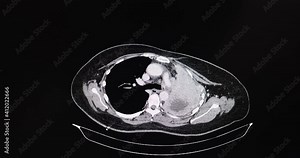 inema CT scan of a chest of a patient with lung cancer. The tumor causes total left lung atelectasis and pleural effusion.