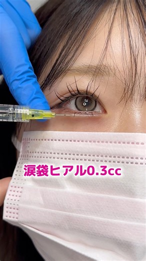 涙袋ヒアル0.3cc🩷-５分でどこまで変わる？-#涙袋ヒアルロン酸 #涙袋メイク #ルラ美容クリニック #ルラ美容クリニック名古屋本院 #名古屋美容クリニック