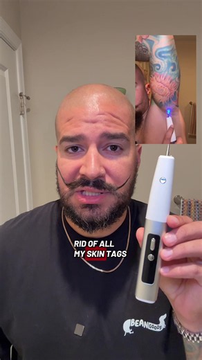 DIY Skin Tag Removal with a Beauty Pen: My Personal Results
