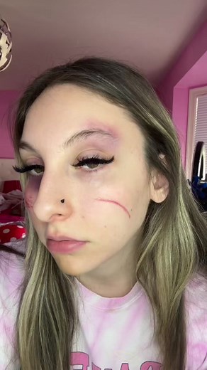 Dealing with Scratches, Bruises, and Wounds: My Story