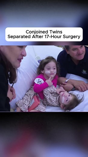 Conjoined Twins Seperated After 17 Hour Surgery #tumor #conjoinedtwin #doctor #conjoined #fyp