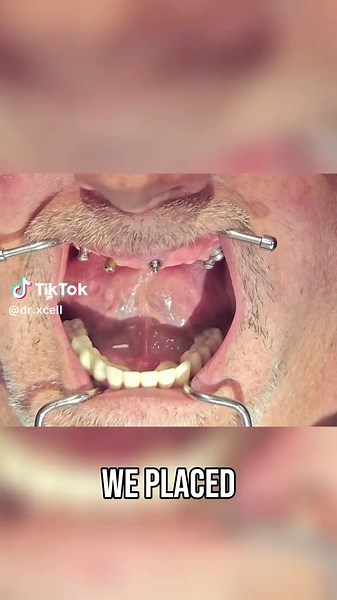 Dental Implants: Multi-Unit Abutment Placement Guide