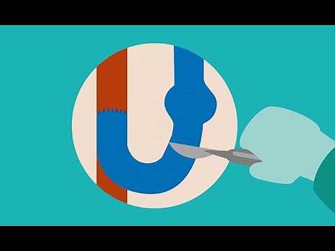 Identifying dialysis fistula complications using ultrasound