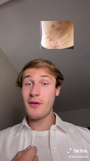 Dealing with Underarm Sweat Bumps and Breakouts