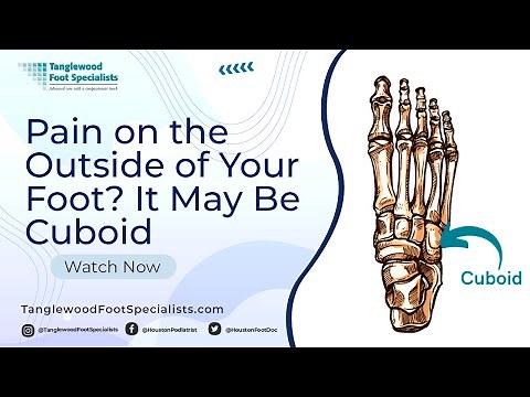Pain on the Outside of Your Foot? It May Be Cuboid Syndrome