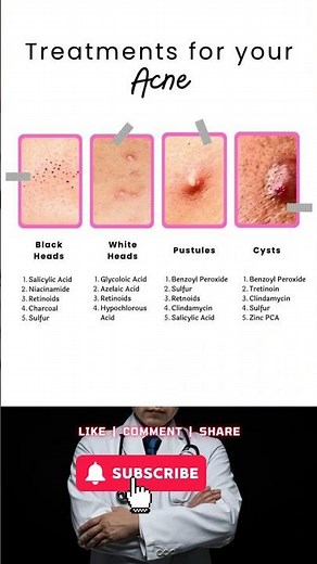 Effective Ways to Help Manage Acne ✨🧴