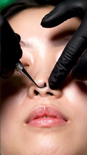 Most Relaxing Blackhead Extraction Ever | ASMR