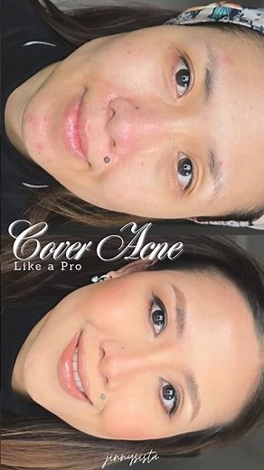 How to cover acne like a pro #makeuptutorial