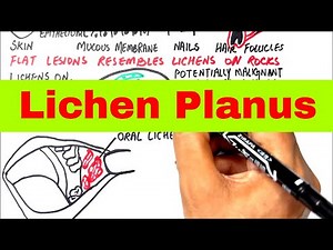 Oral Lichen Planus | Etiology, Pathophysiology, Histopathology, Diagnosis, & Management