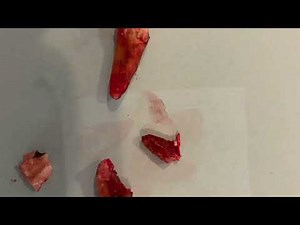 The Worst 20 Root Canal Removal Infections Ever Seen - dental infections like never seen before